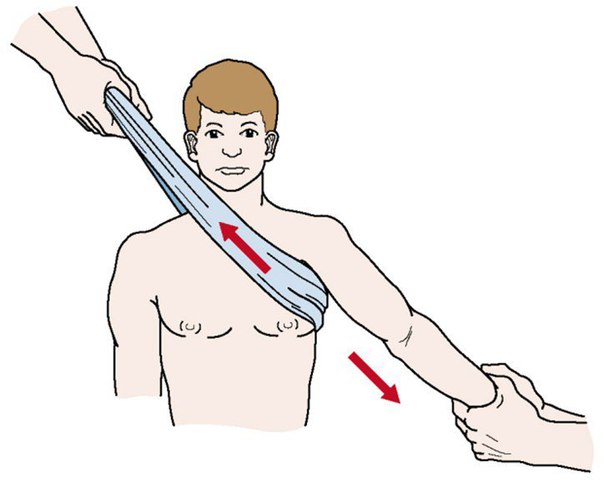 Как выправить вывих плеча